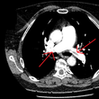 CT angiografie plícnice a jejích větví potvrzující oboustrannou plicní embolii